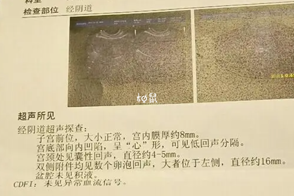 超声检查可以确诊纵隔子宫