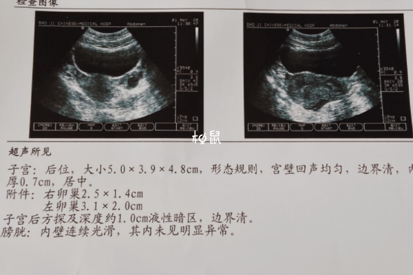 生殖器官异常会导致子宫内膜异位症