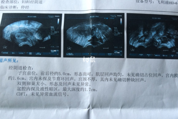 宫颈糜烂可能是多次人流造成的