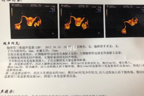 输卵管积水可能会腹痛