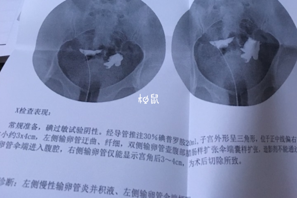 输卵管积水做试管很难成功