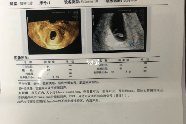 习惯性流产可以生育