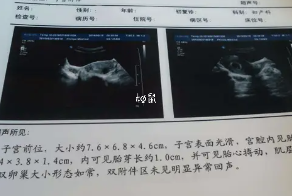 多囊过了3个月可能会胎停育