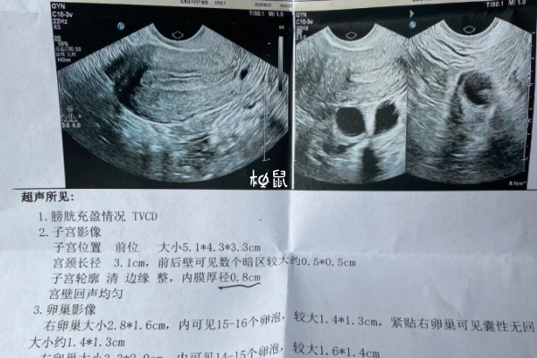 卵泡长着长着就不见了可能是激素异常