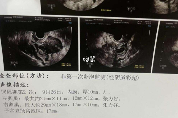 取卵时机不正确会出现空卵泡