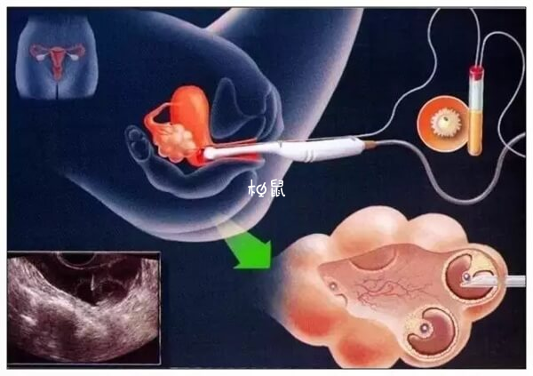 取卵手术图