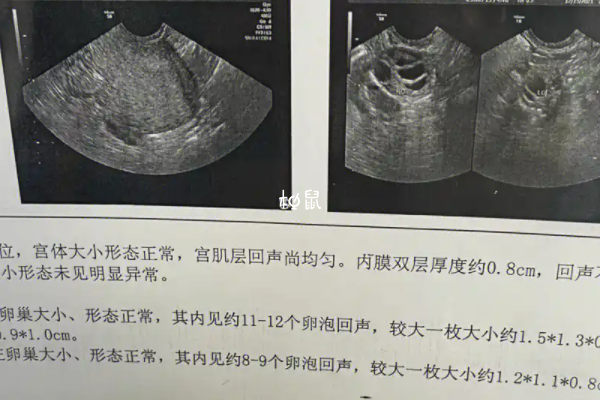 试管前做afc窦卵泡检查收费并不贵