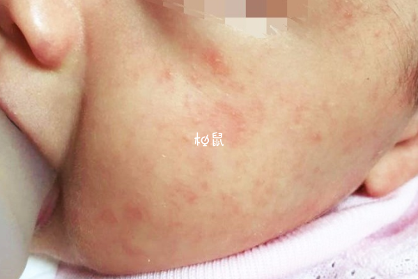 新生儿脸上长红疹可能是幼儿急疹