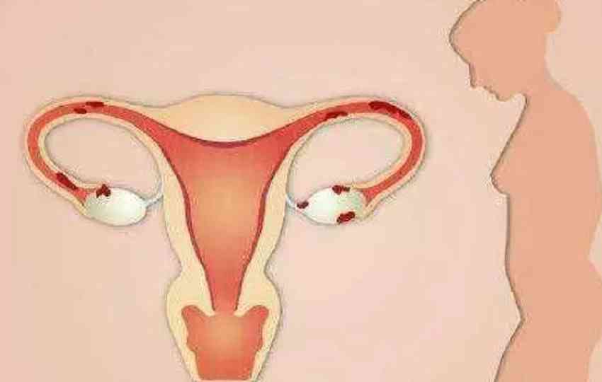 多囊卵巢调理后能不能怀孕生孩子？