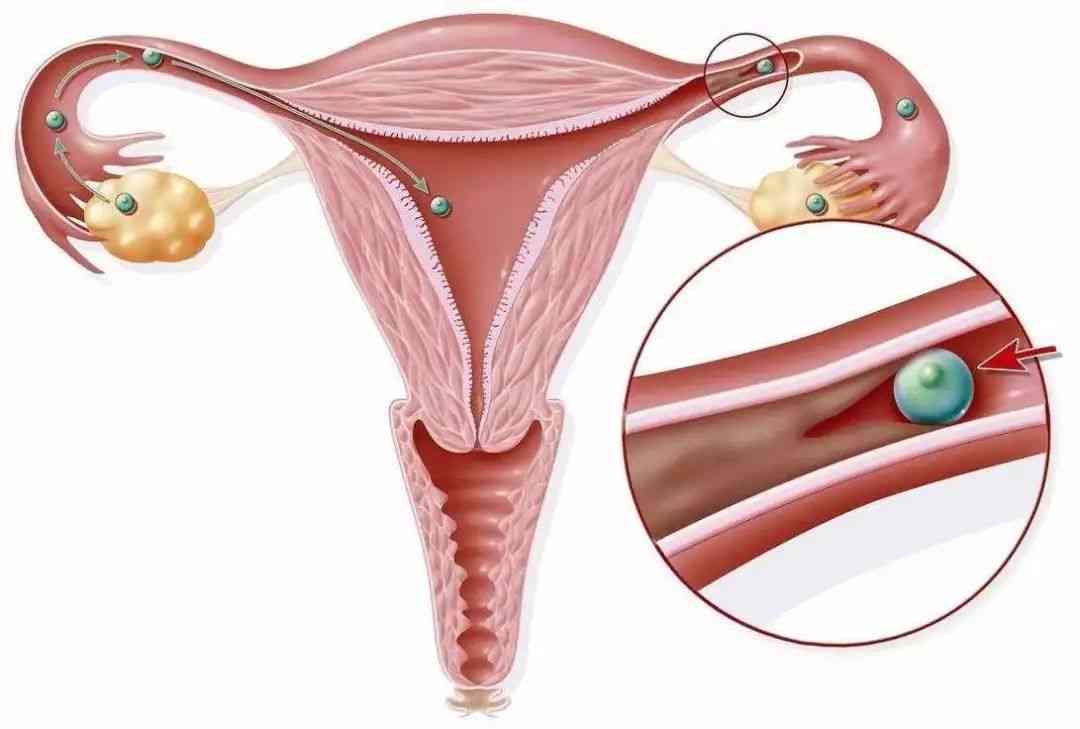 宫腔粘连是否会导致胎儿胎停育？