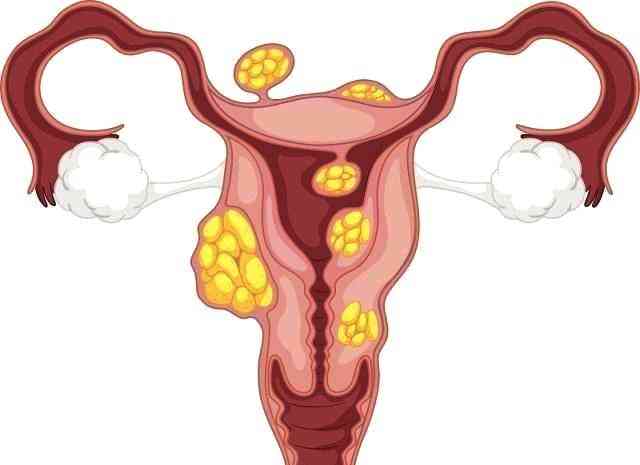 多囊卵巢综合症患者异常出血怎么办？