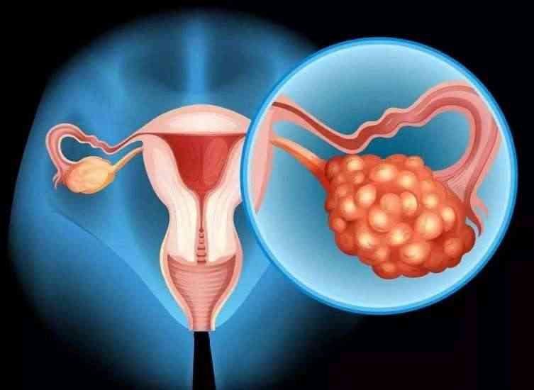 多囊卵巢要怎么样才能怀孕？