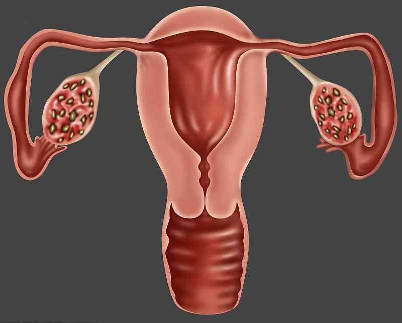 多囊卵巢的女性怎么调理月经？
