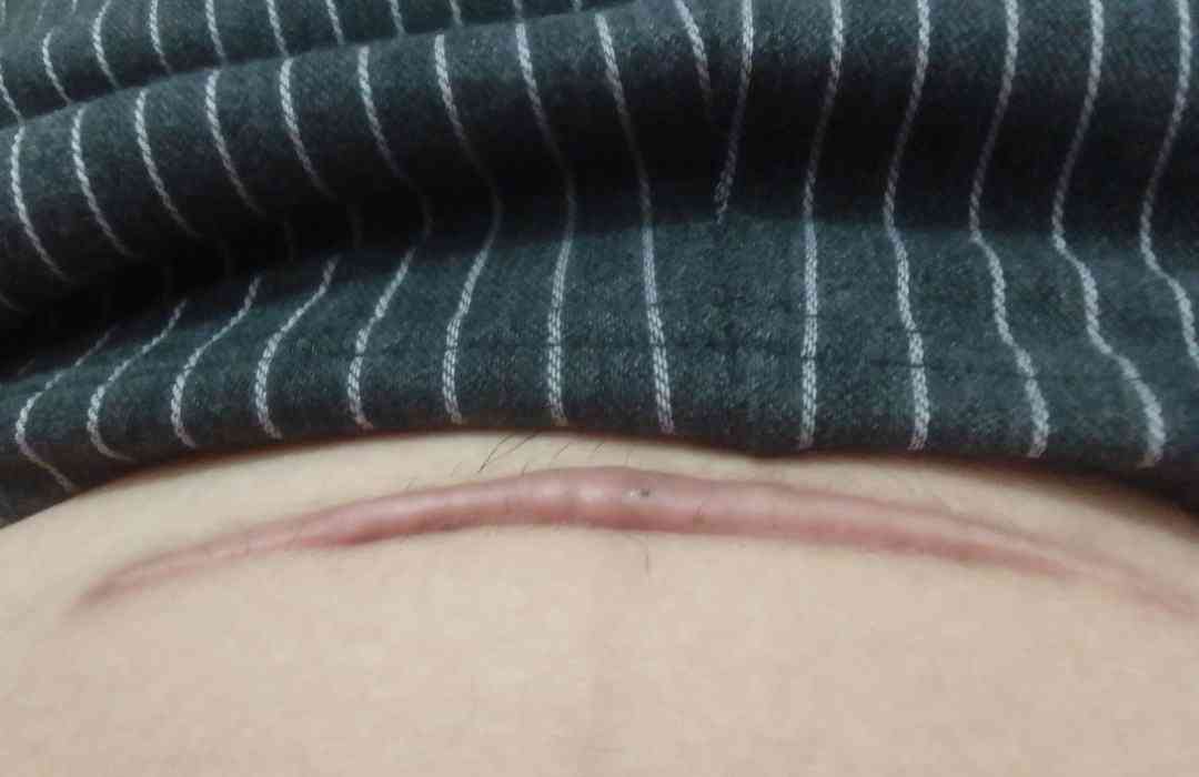三胎子宫疤痕厚度标准是多少？