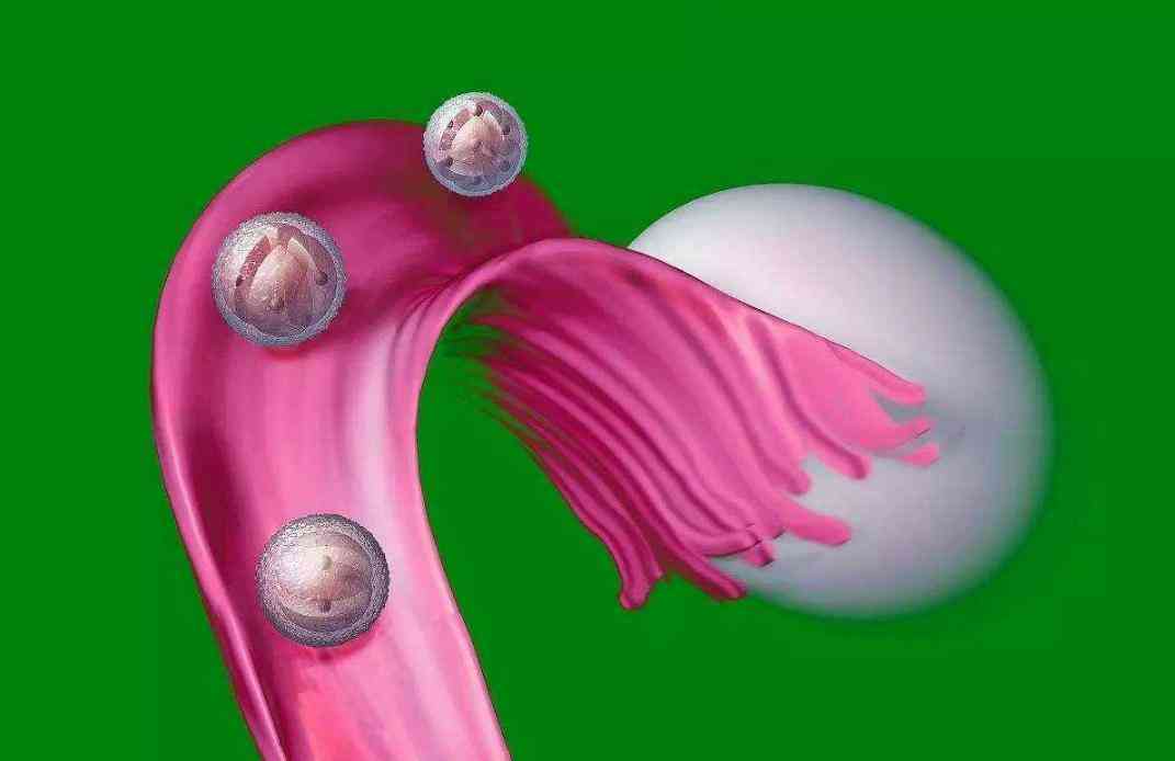 诱发女性多囊卵巢的原因有哪些？
